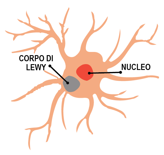 schema corpi di Lewy e nucleo