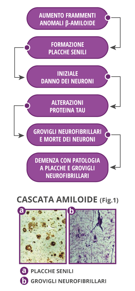 Cause dell'Alzheimer: deposito beta-amiloide, formazione delle placche senili, alterazione della proteina Tau, morte dei neuroni. 